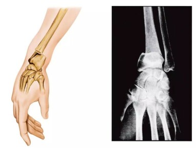 COLLES FRAKTUR: Brudd i underarmsbeinet (radius). Skjer typisk når man faller og prøver å ta seg for med utstrakt hånd. Foto: NTB Scanpix / Science Photo Library COLLES FRAKTUR: Brudd i underarmsbeinet (radius). Skjer typisk når man faller og prøver å ta seg for med utstrakt hånd. Foto: NTB Scanpix / Science Photo Library